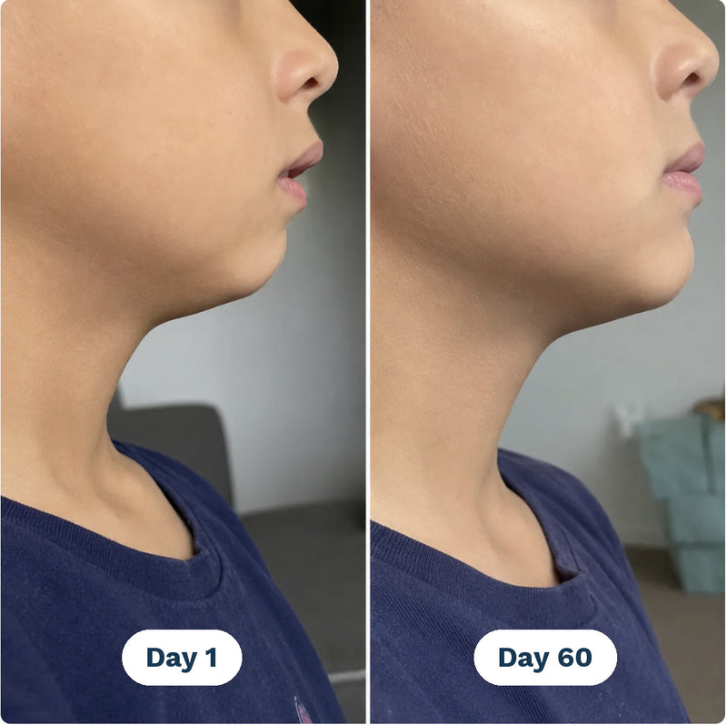 Jaw and neck line in profile, day 1 and day 60